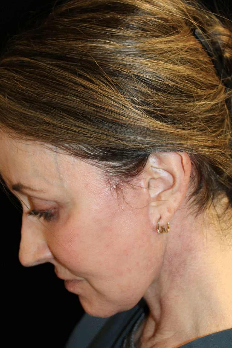 After Image: Deep Plane Face & Neck Lift - left-side