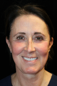 Before Image: Deep Plane Face & Neck Lift