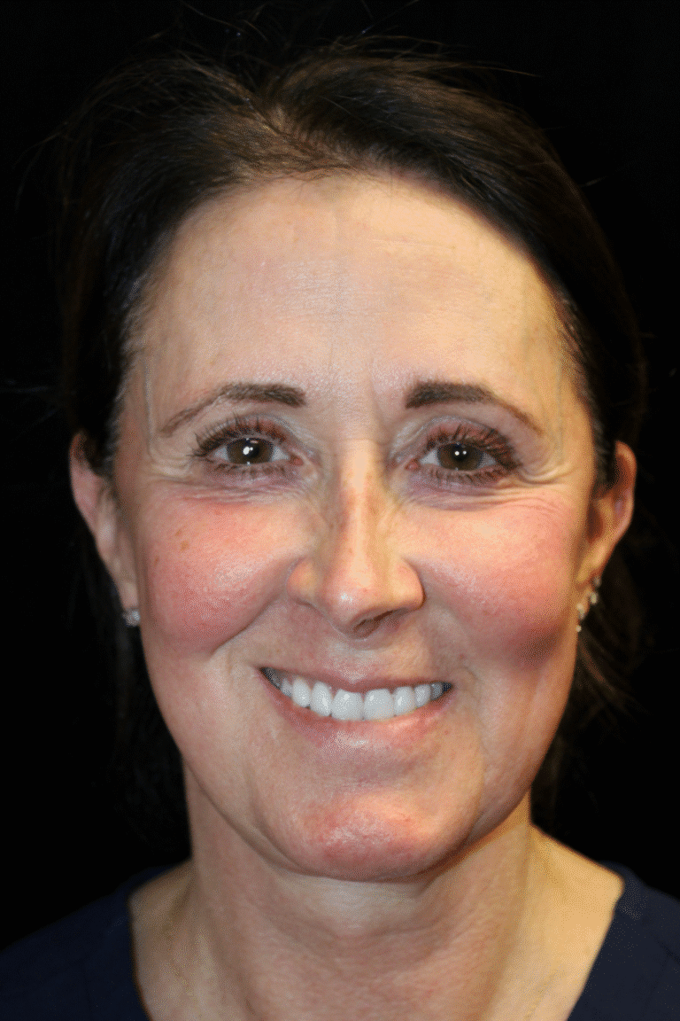 Before Image: Deep Plane Face & Neck Lift - front