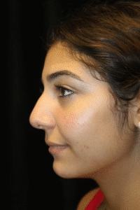 Before Image: Preservation Rhinoplasty
