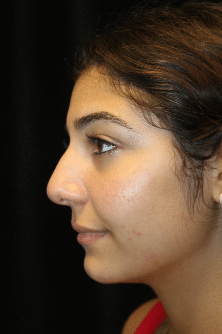 Before Image: Preservation Rhinoplasty - left-side