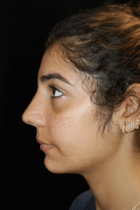 After Image: Preservation Rhinoplasty
