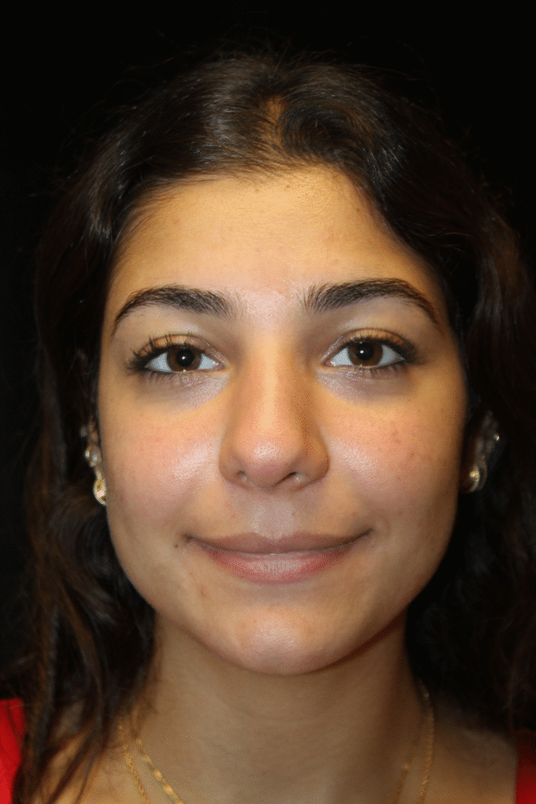 Before Image: Preservation Rhinoplasty - front