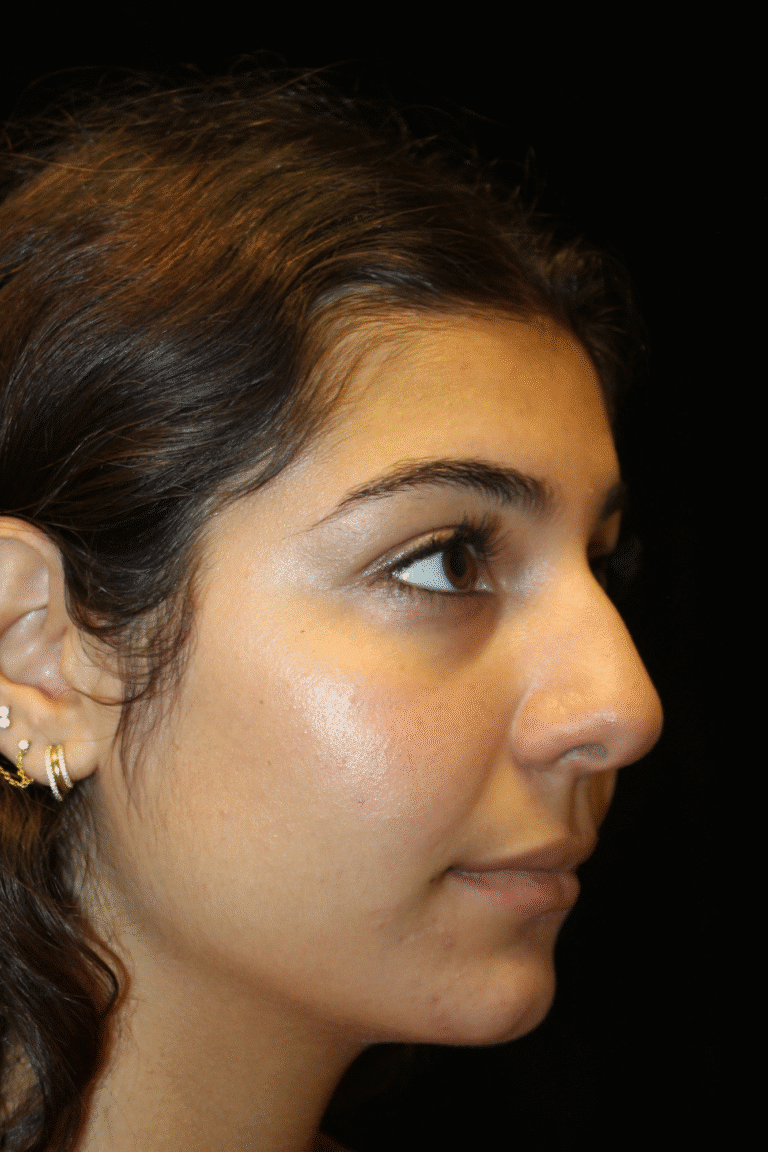 Before Image: Preservation Rhinoplasty - right-front-oblique