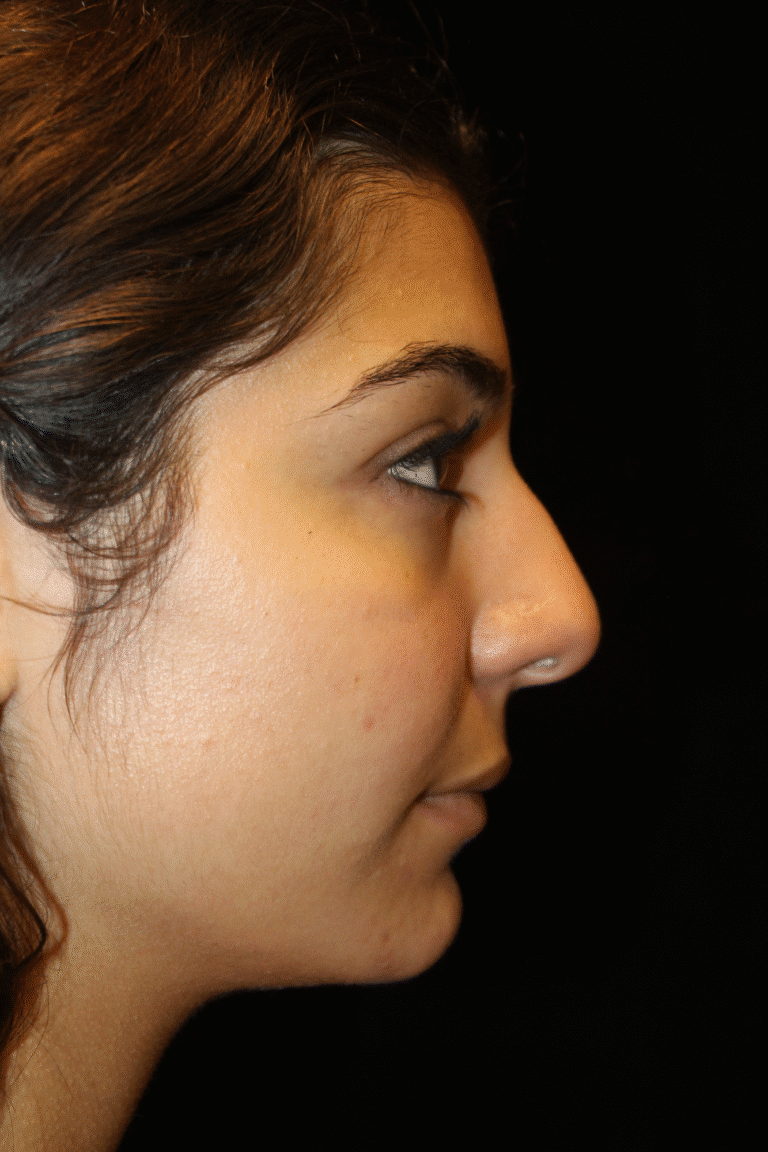 Before Image: Preservation Rhinoplasty - right-side
