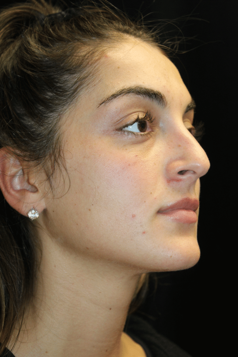 Before Image: Preservation Rhinoplasty - right-front-oblique