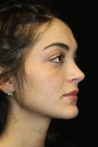 After Image: Preservation Rhinoplasty