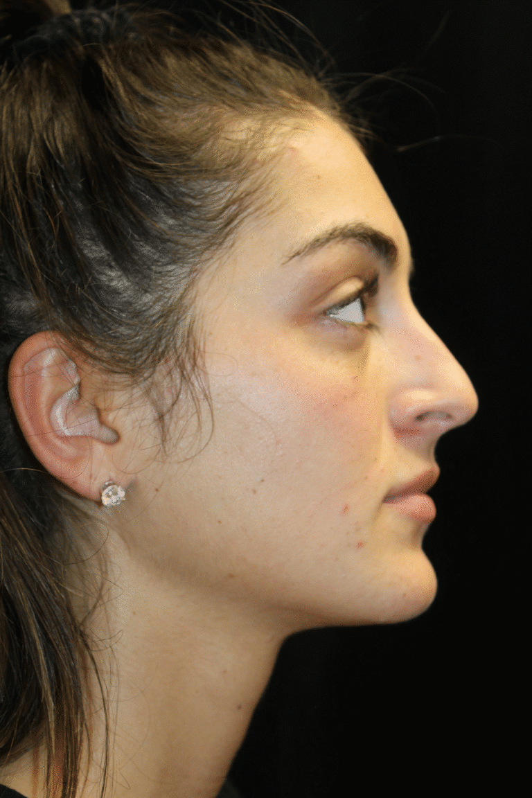 Before Image: Preservation Rhinoplasty - right-side