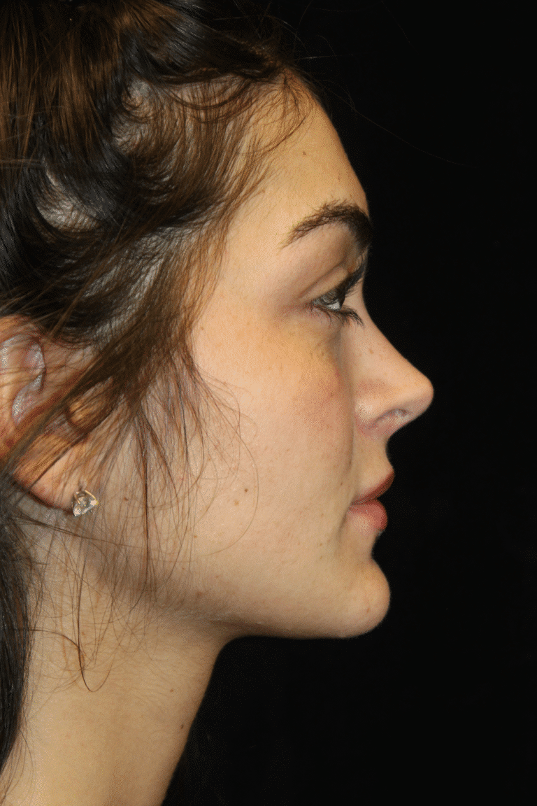 After Image: Preservation Rhinoplasty - right-side