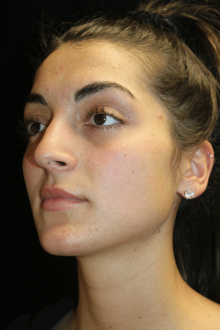 Before Image: Preservation Rhinoplasty - left-front-oblique
