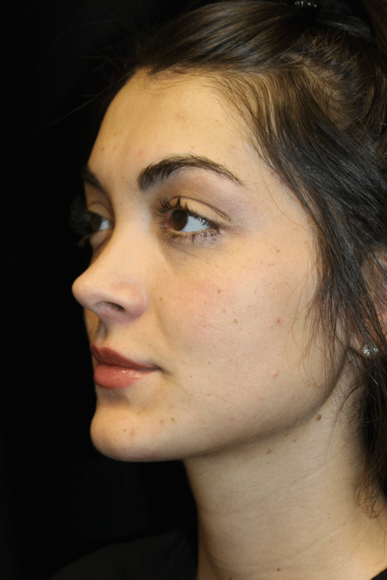 After Image: Preservation Rhinoplasty - left-front-oblique