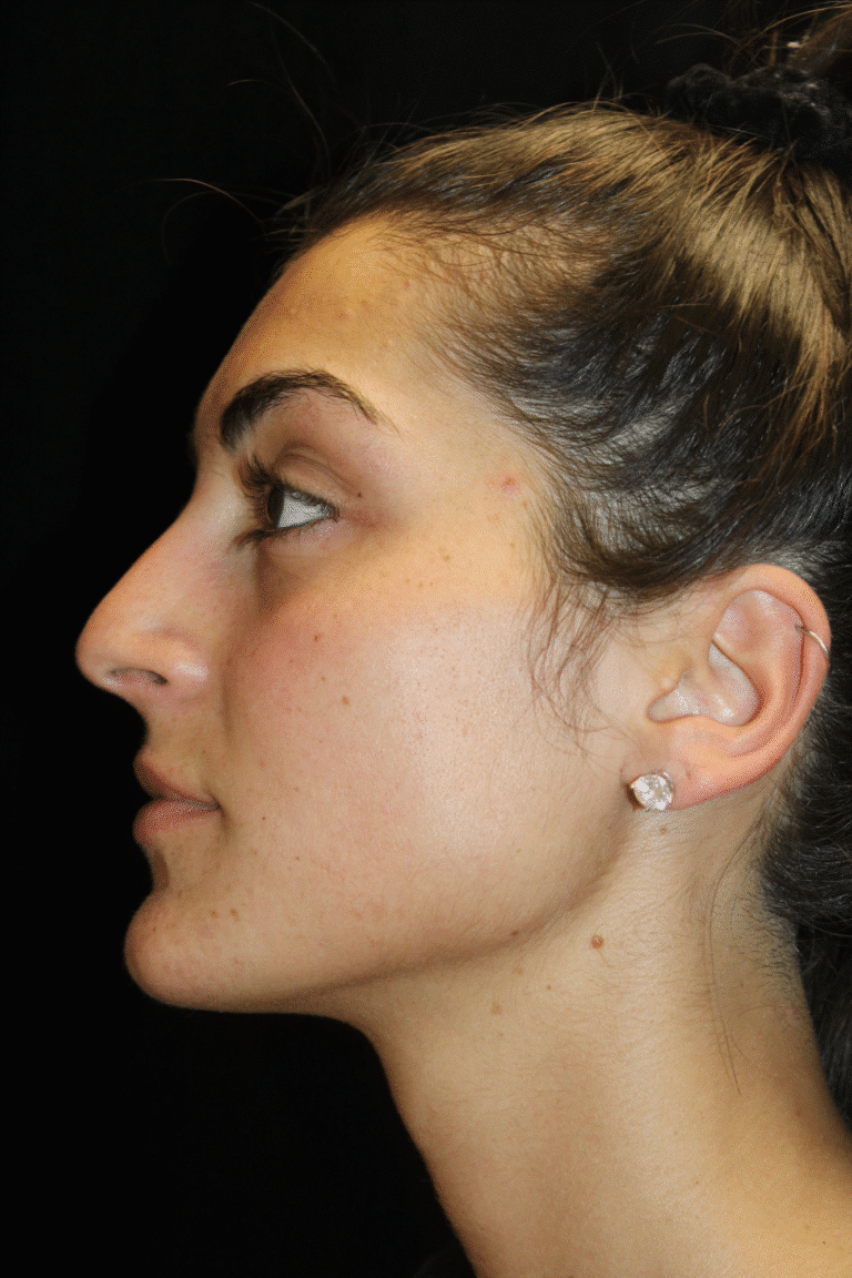 Before Image: Preservation Rhinoplasty - left-side