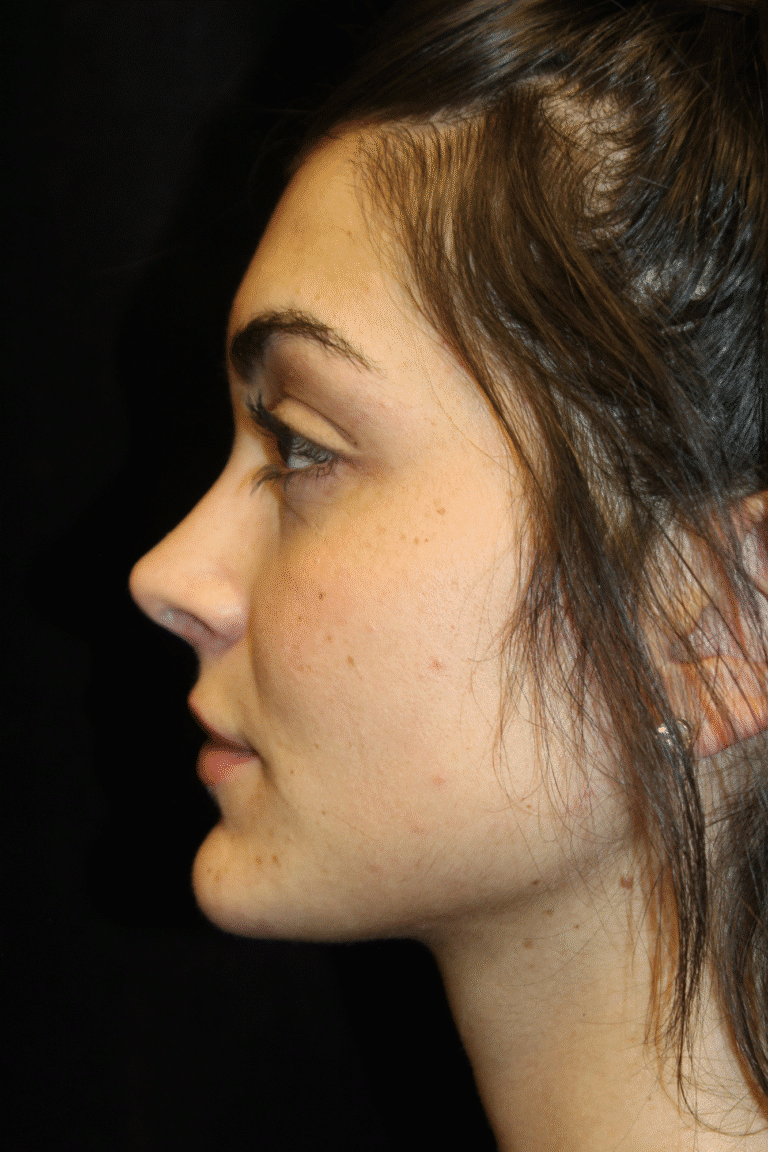After Image: Preservation Rhinoplasty - left-side