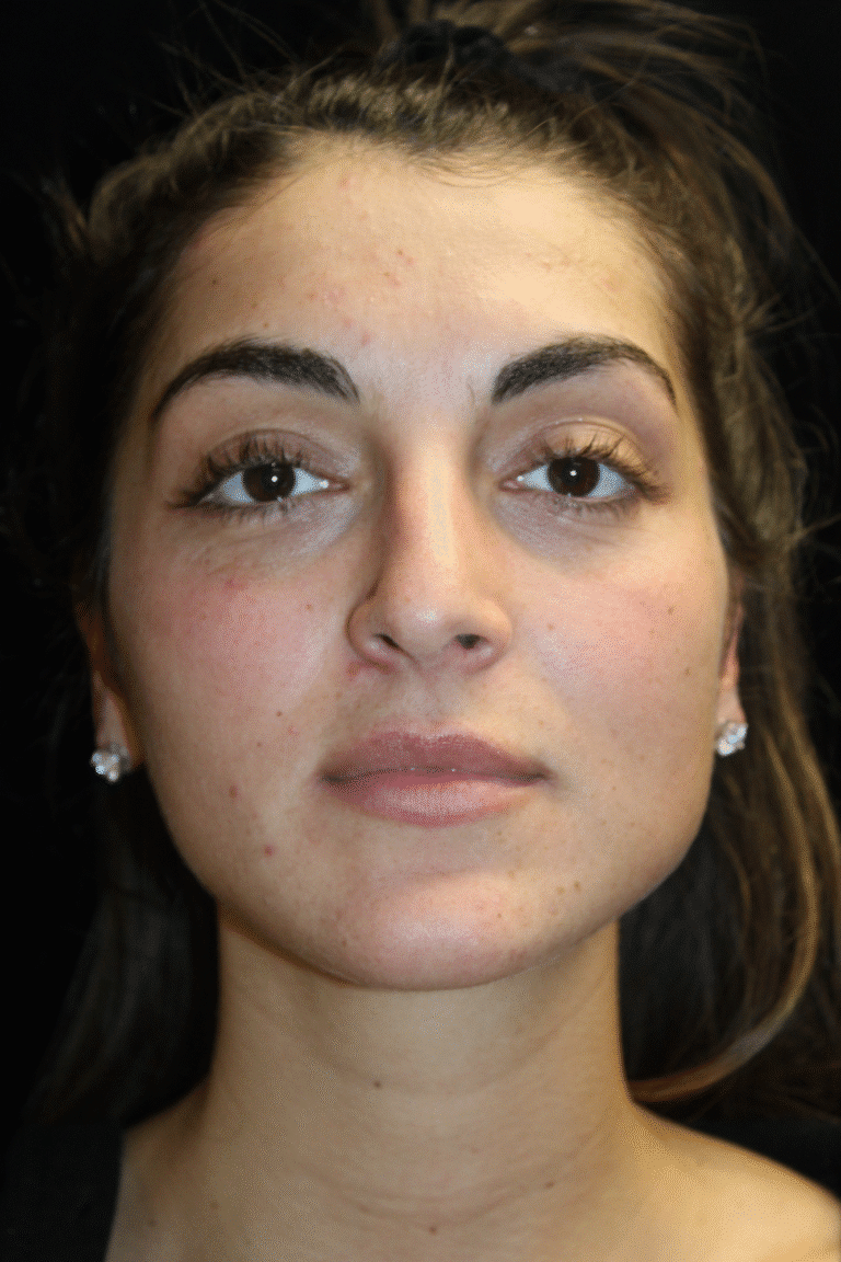 Before Image: Preservation Rhinoplasty - front