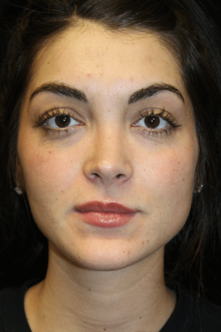 After Image: Preservation Rhinoplasty - front