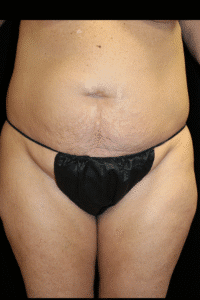 Before Image: Abdominoplasty, Pubic Lift, and Liposuction