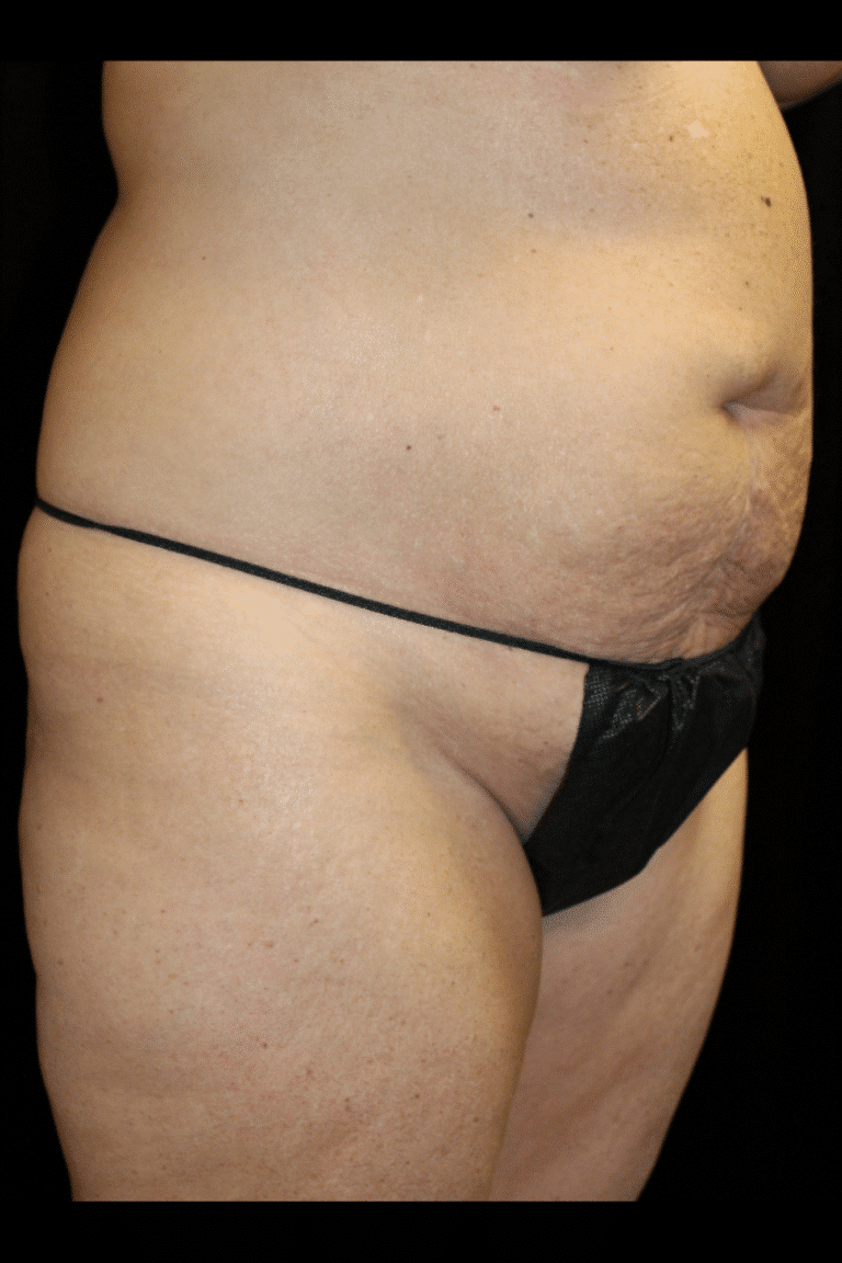 Before Image: Abdominoplasty, Pubic Lift, and Liposuction - right-front-oblique