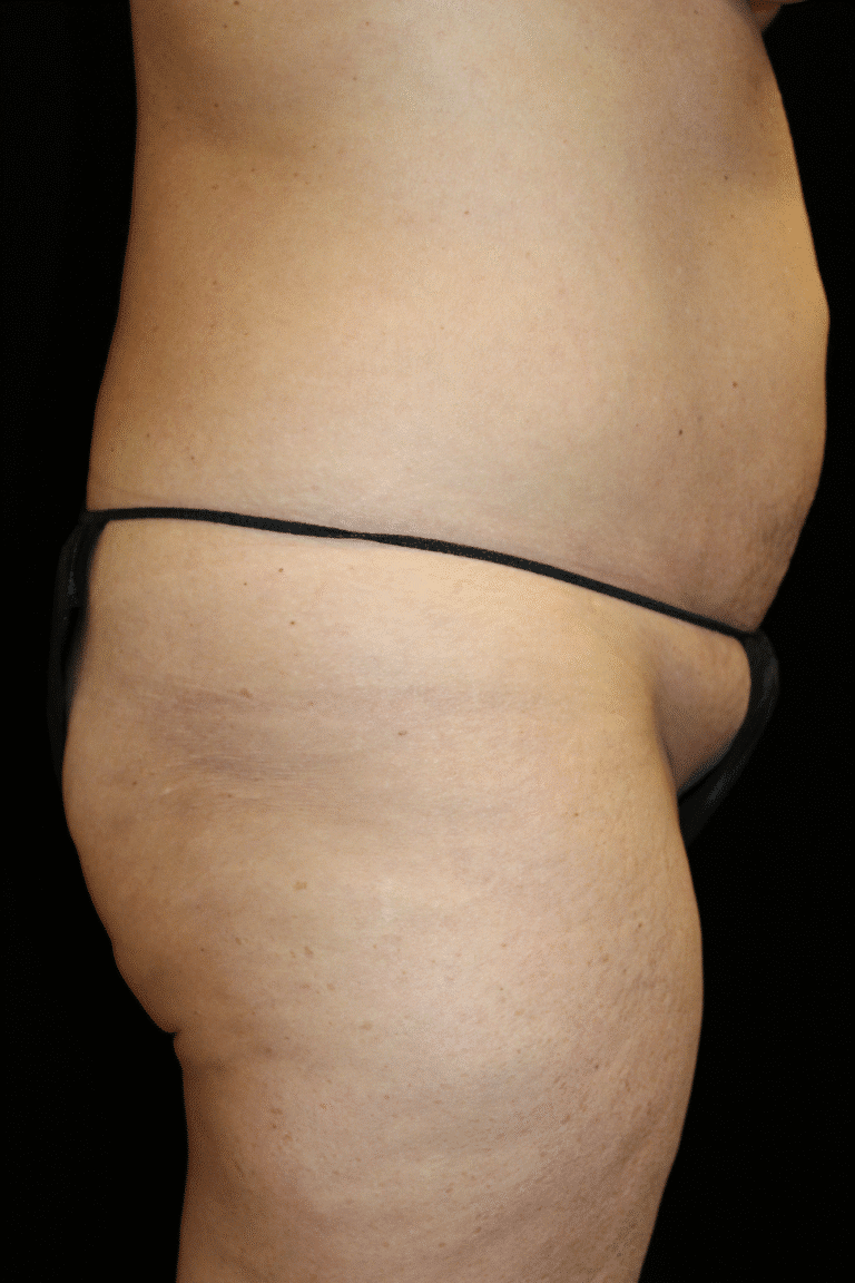 Before Image: Abdominoplasty, Pubic Lift, and Liposuction - right-side