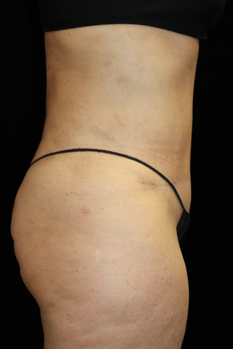 After Image: Abdominoplasty, Pubic Lift, and Liposuction - right-side