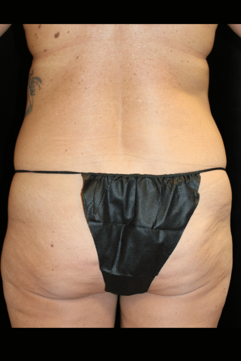 Before Image: Abdominoplasty, Pubic Lift, and Liposuction - back