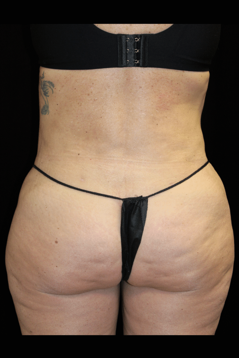 After Image: Abdominoplasty, Pubic Lift, and Liposuction - back