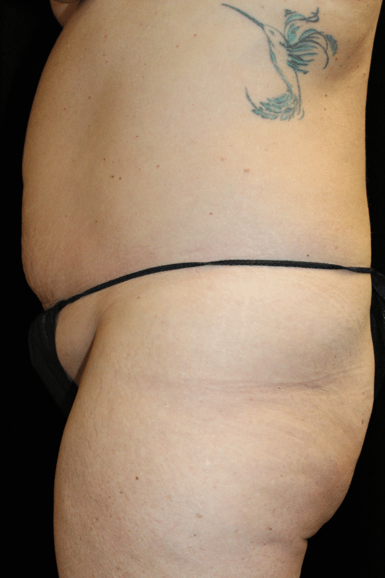 Before Image: Abdominoplasty, Pubic Lift, and Liposuction - left-side