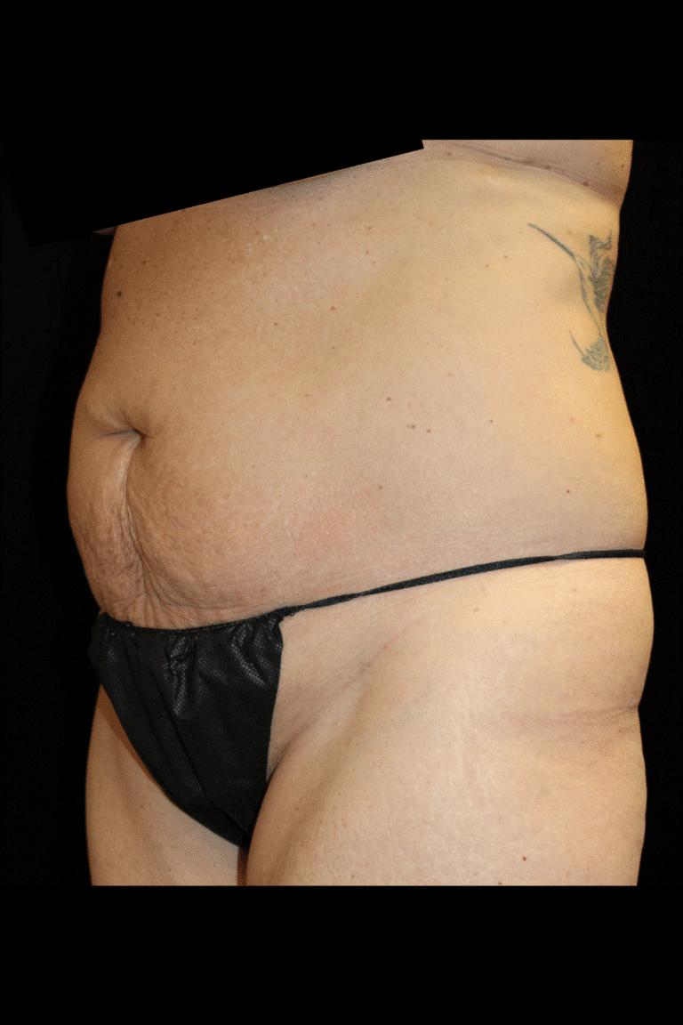 Before Image: Abdominoplasty, Pubic Lift, and Liposuction - left-front-oblique