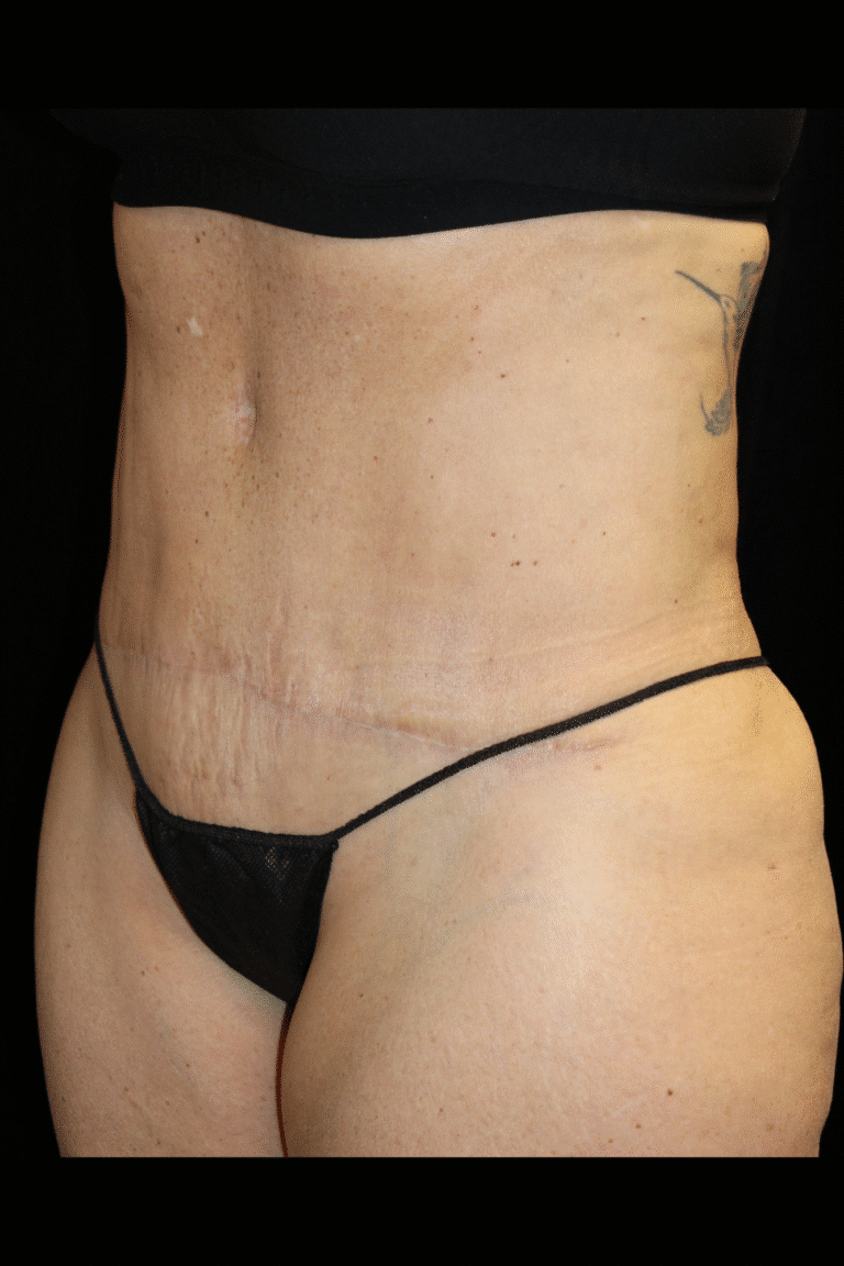 After Image: Abdominoplasty, Pubic Lift, and Liposuction - left-front-oblique