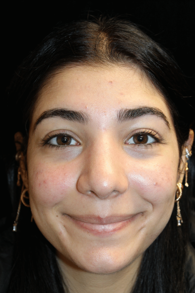 After Image: Preservation Rhinoplasty - front