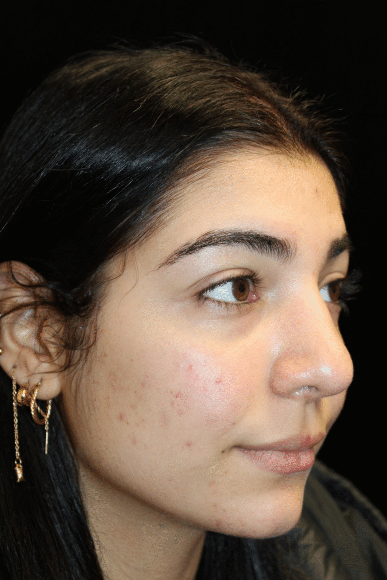 After Image: Preservation Rhinoplasty - right-front-oblique