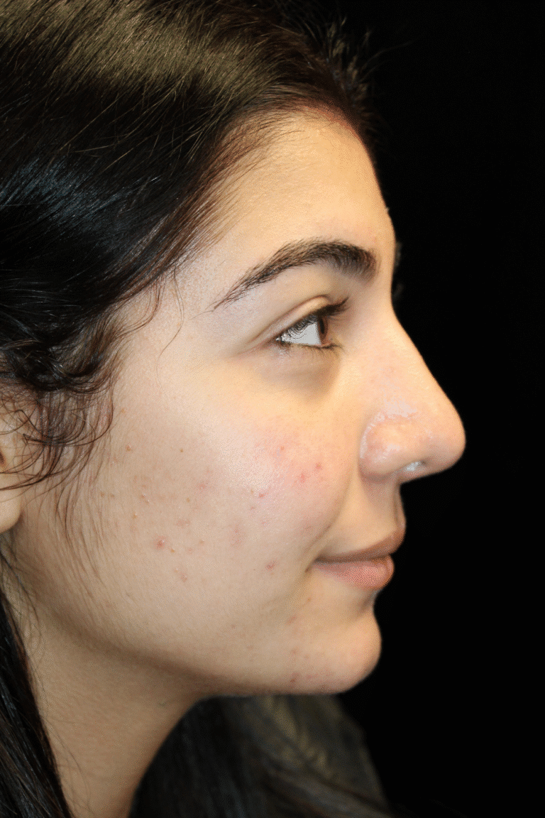After Image: Preservation Rhinoplasty - right-side
