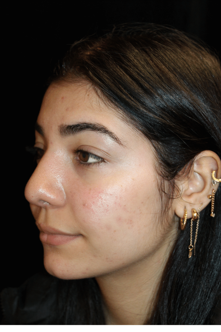 After Image: Preservation Rhinoplasty - left-front-oblique