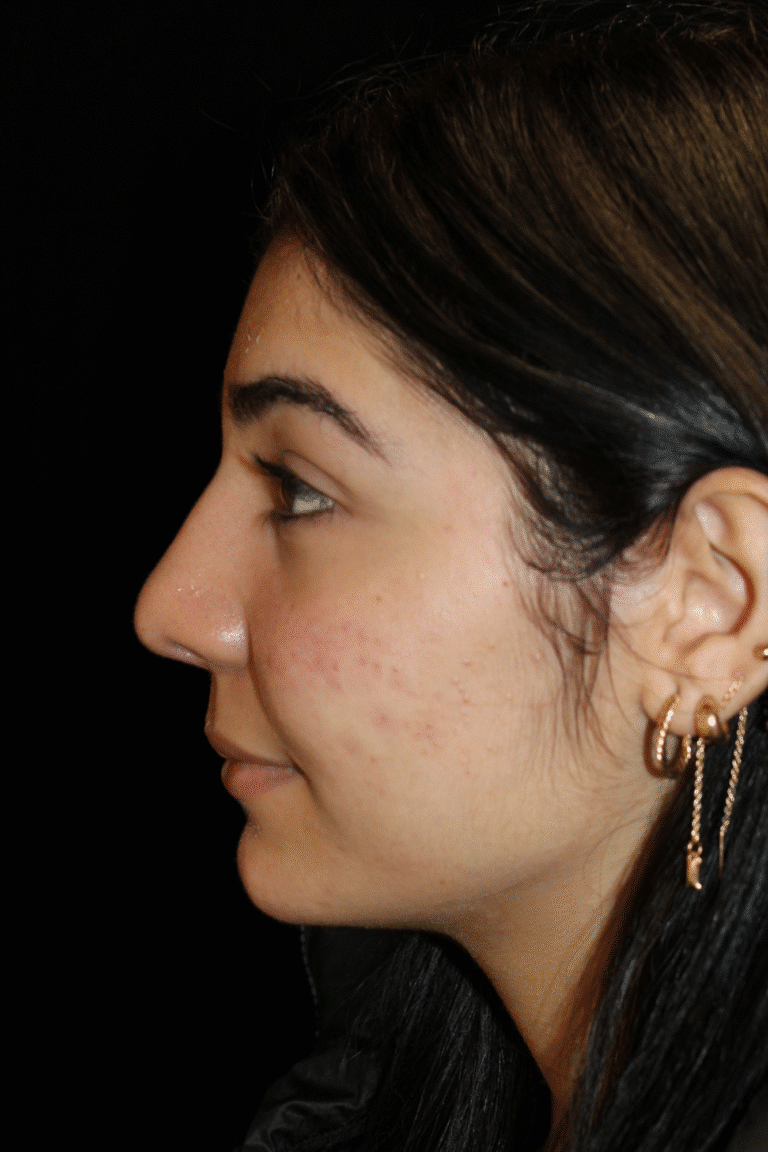 After Image: Preservation Rhinoplasty - left-side