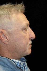 Before Image: Preservation Rhinoplasty