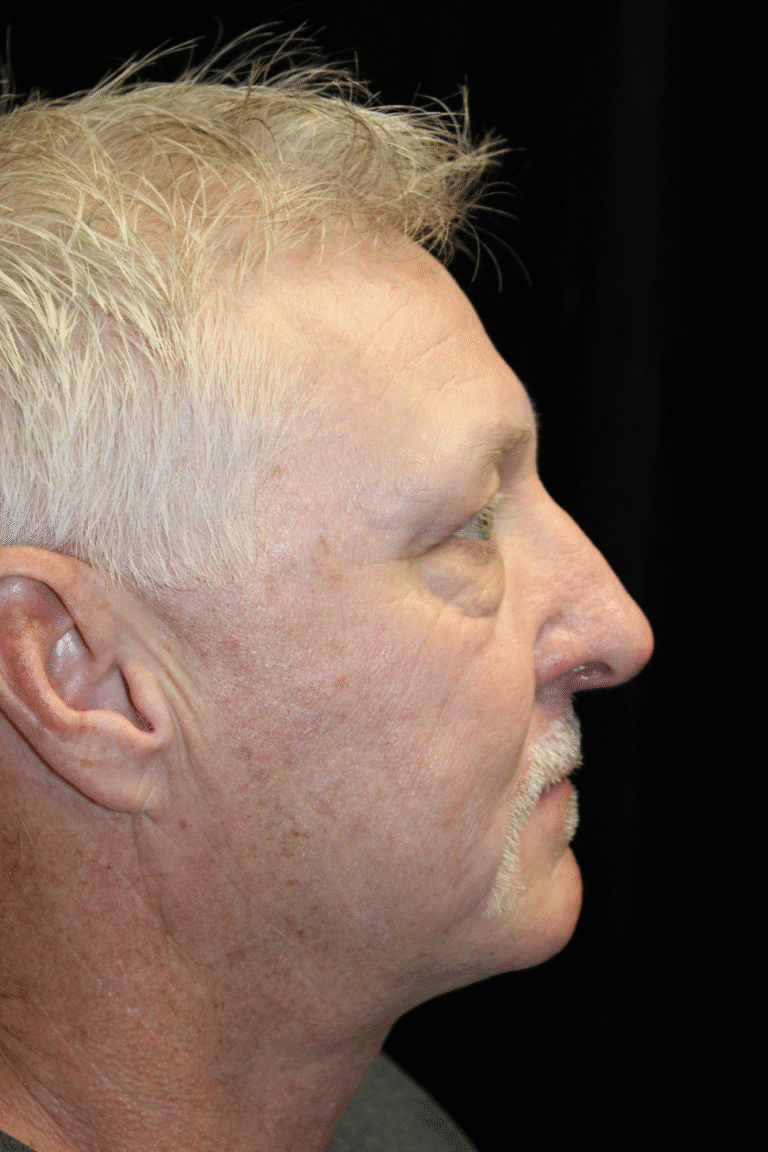 After Image: Preservation Rhinoplasty - right-side