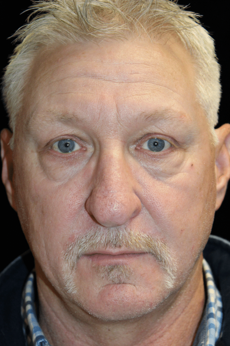 Before Image: Preservation Rhinoplasty - front