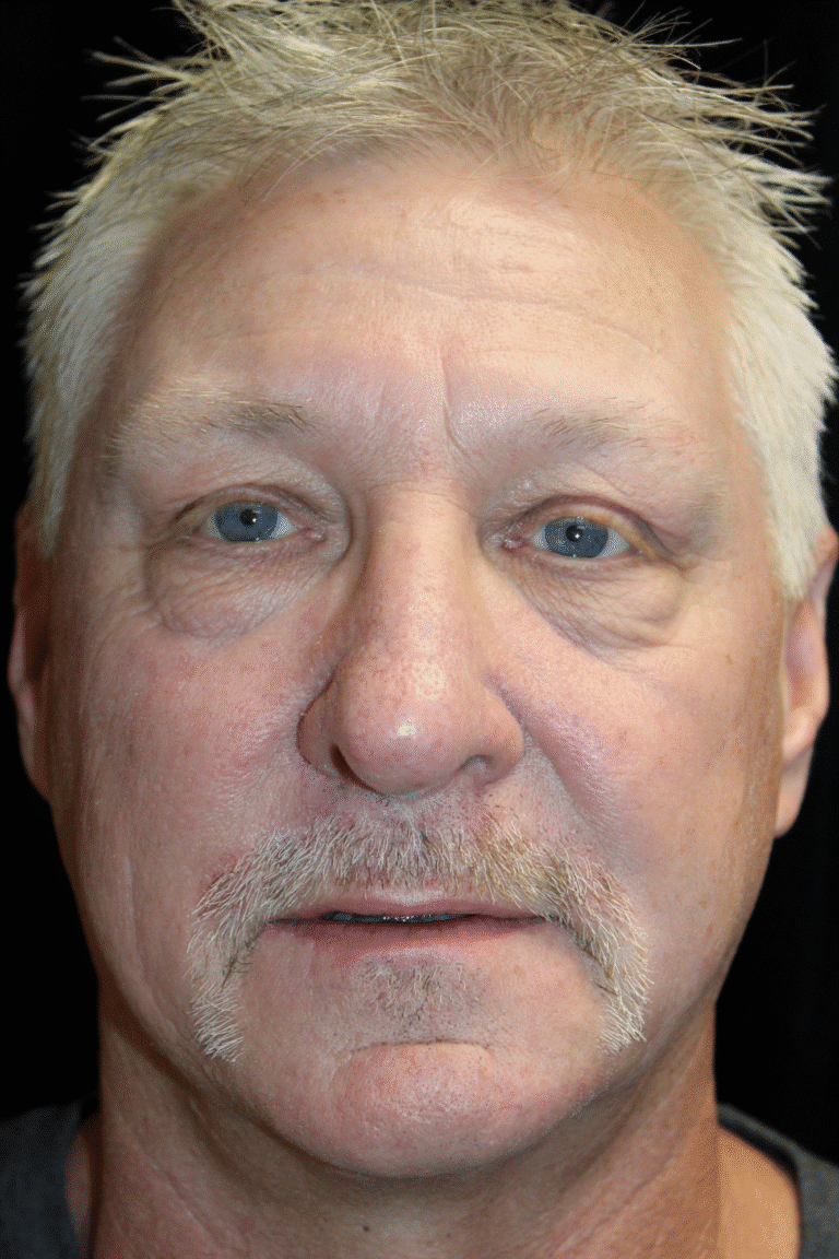 After Image: Preservation Rhinoplasty - front