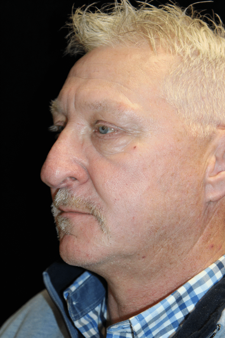 Before Image: Preservation Rhinoplasty - left-front-oblique