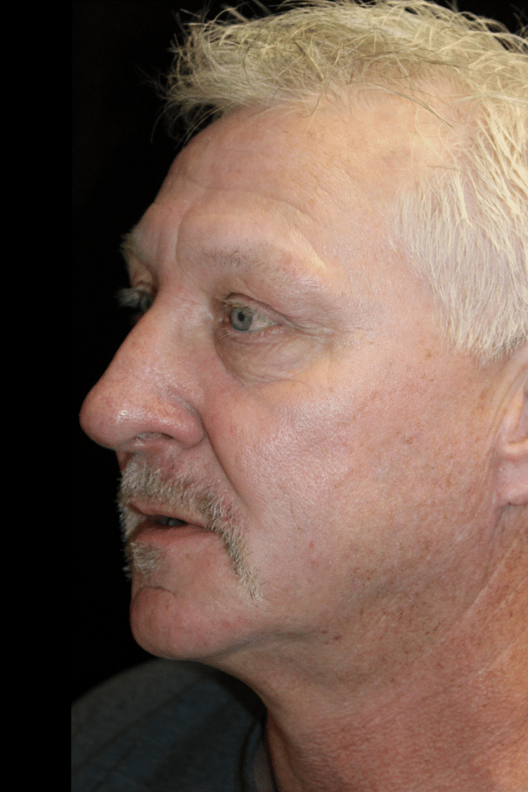 After Image: Preservation Rhinoplasty - left-front-oblique