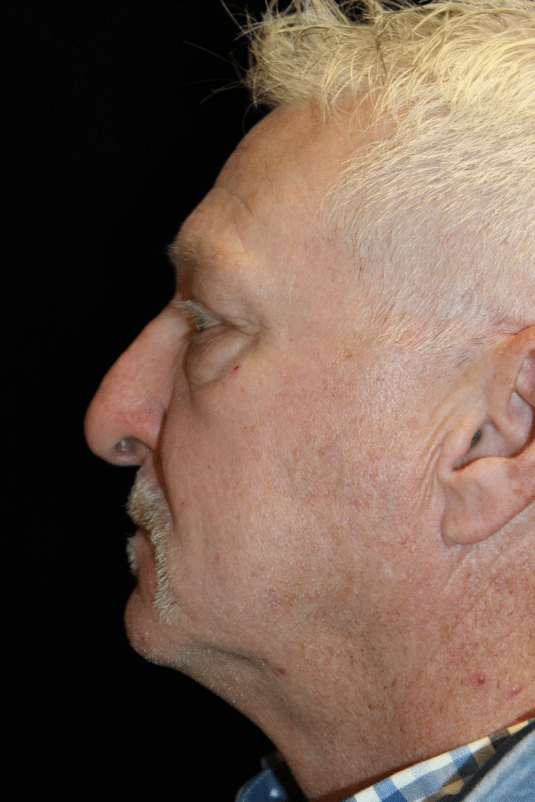 Before Image: Preservation Rhinoplasty - left-side