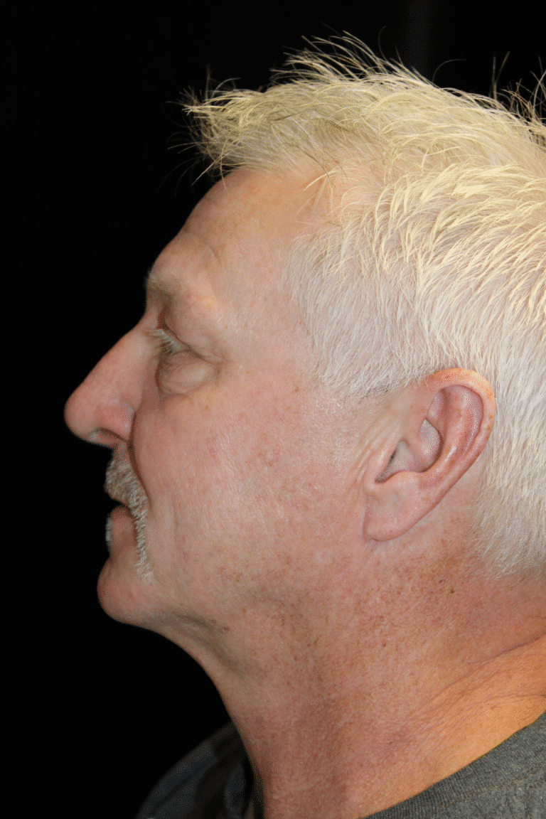 After Image: Preservation Rhinoplasty - left-side