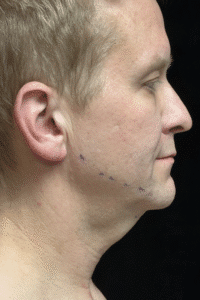 Before Image: Neck Lift