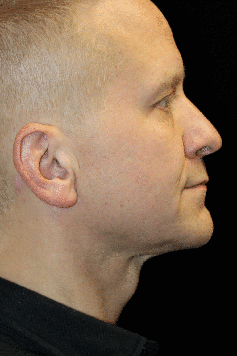 After Image: Neck Lift - right-side
