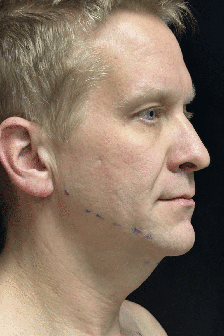 Before Image: Neck Lift - right-front-oblique