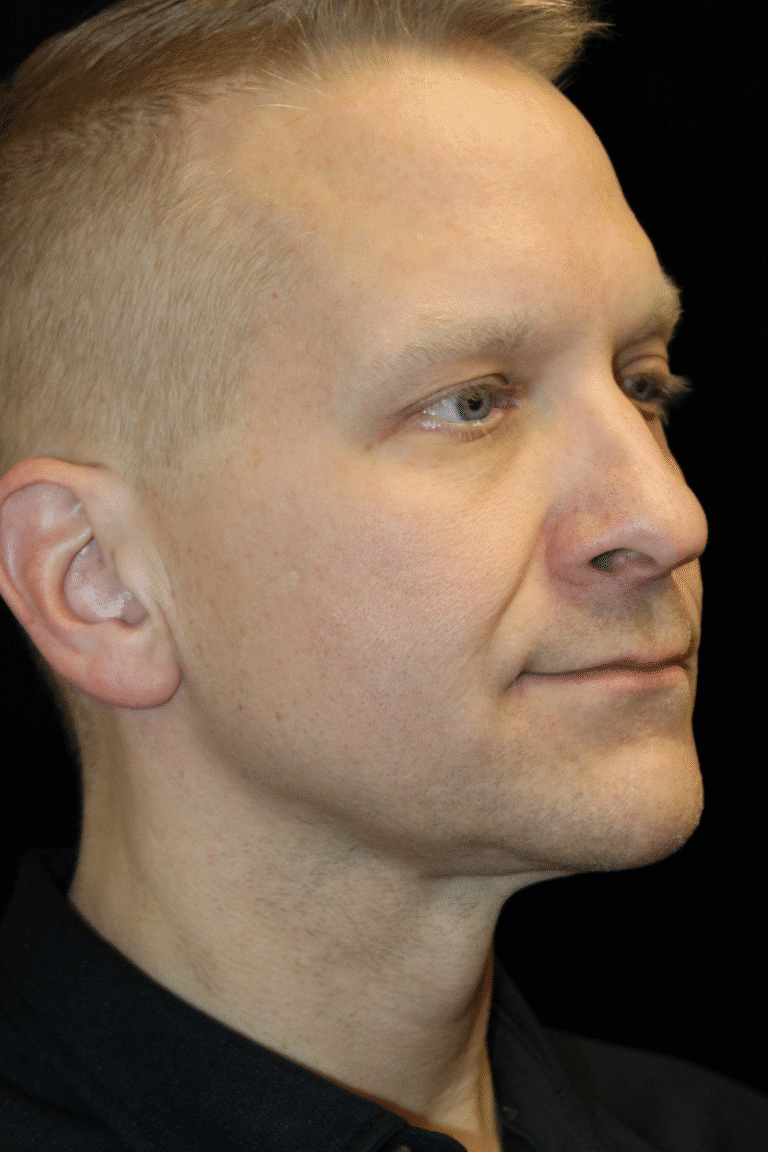 After Image: Neck Lift - right-front-oblique