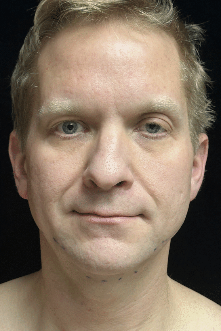 Before Image: Neck Lift - front