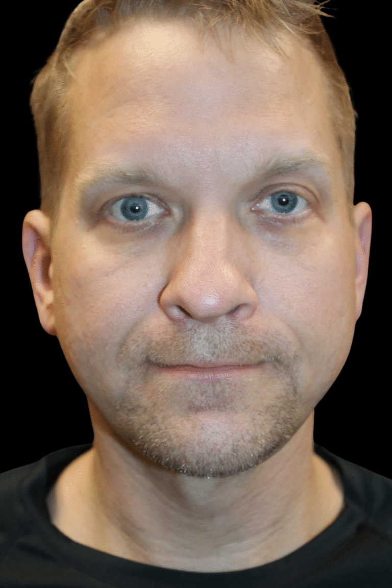 After Image: Neck Lift - front