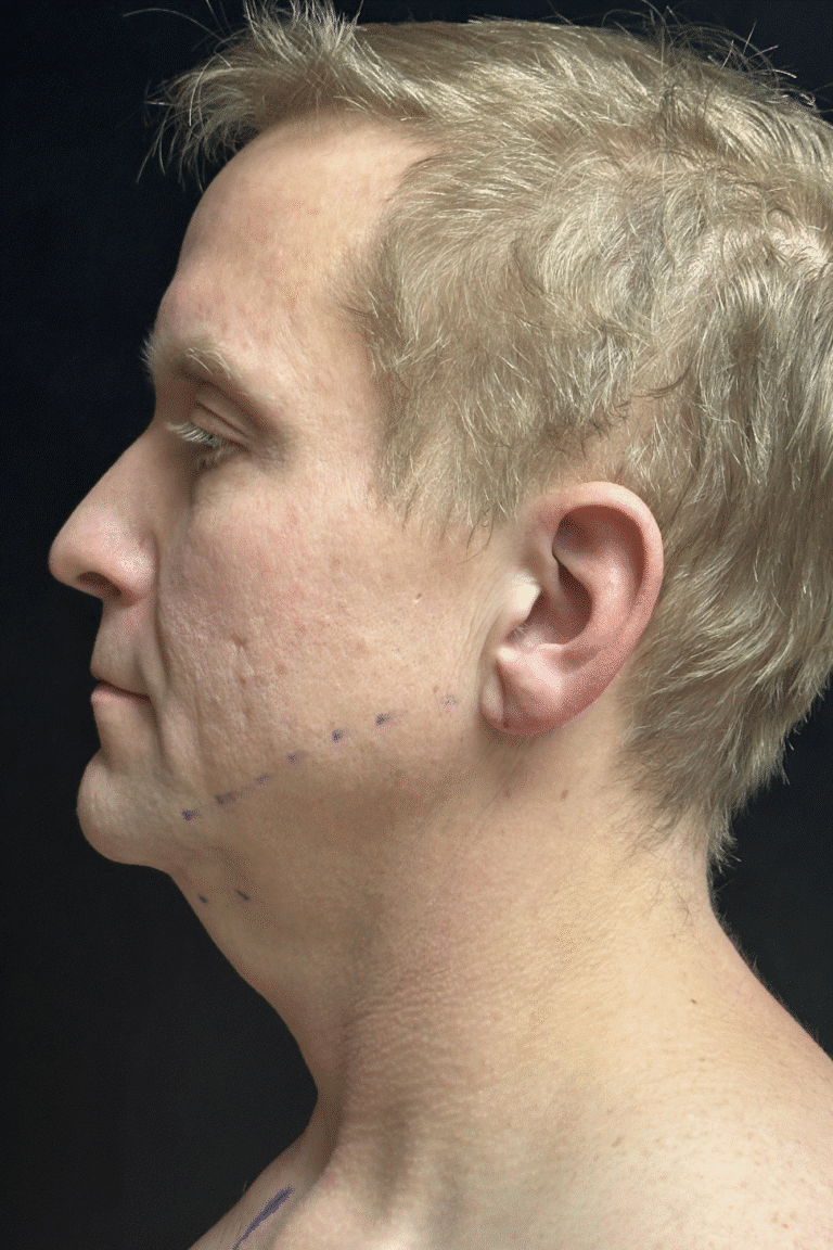 Before Image: Neck Lift - left-side