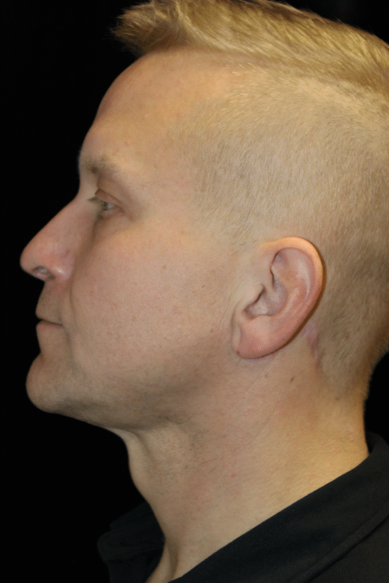 After Image: Neck Lift - left-side