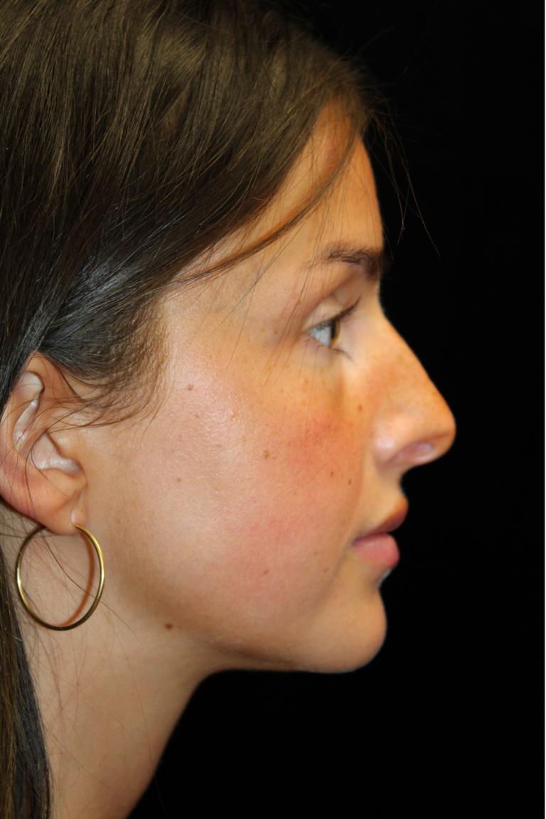 Before Image: Closed Preservation Septorhinoplasty - 